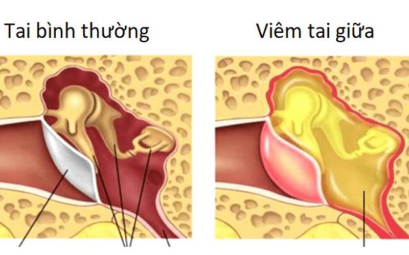 Viêm tai giữa mạn tính là gì
