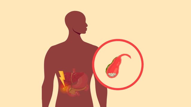 Viêm túi mật do sỏi: Cơ chế hình thành và cách ngăn ngừa