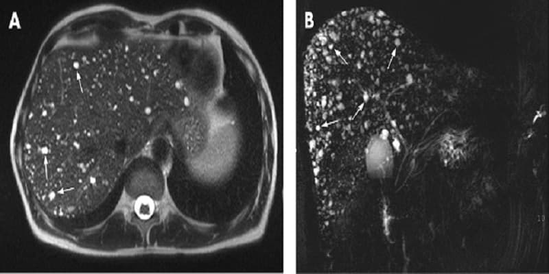 Chụp cộng hưởng từ MRI cho gan có giá trị cao trong quá trình chẩn đoán, theo dõi các tổn thương ở trong gan