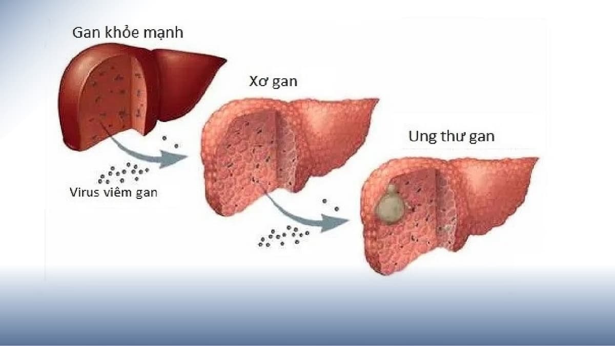 Xơ gan triệu chứng là gì, biến chứng ra sao?