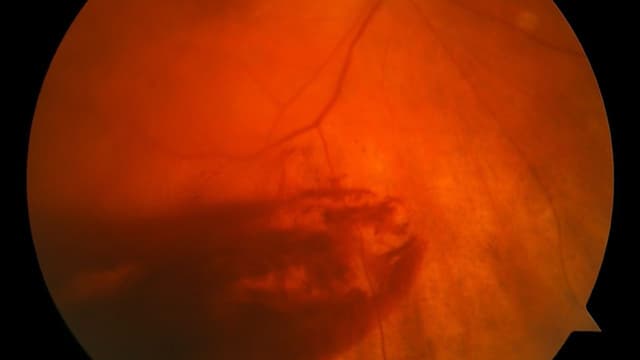 Xuất huyết dịch kính sau chấn thương – Nguyên nhân và điều trị