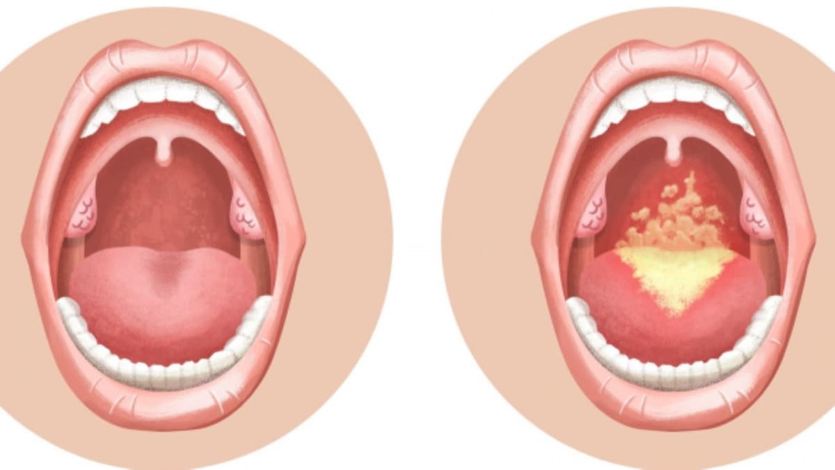 Dấu hiệu điển hình của bệnh nấm quanh miệng cần lưu ý