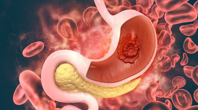 Triệu chứng bệnh thực quản: Nhận biết sớm để ngừa biến chứng