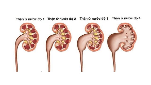 Cách chữa thận ứ nước hiệu quả bảo vệ sức khỏe thận