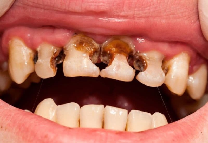 Nguyên nhân gây ra sâu răng là vi khuẩn trong miệng chuyển hóa đường và tinh bột thành acid, tấn công men răng và gây ra các lỗ sâu