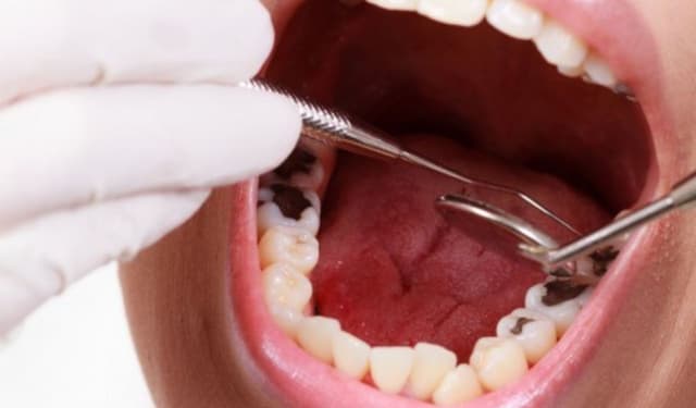 Cách khắc phục sâu răng hiệu quả giúp hạn chế biến chứng