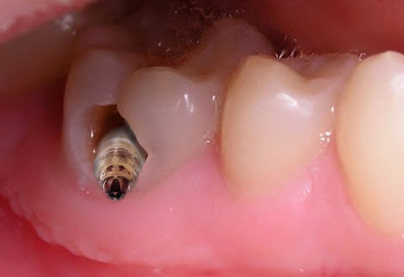 Cách vệ sinh răng sâu đúng cách giúp giảm đau, kiểm soát vi khuẩn và hỗ trợ điều trị hiệu quả.