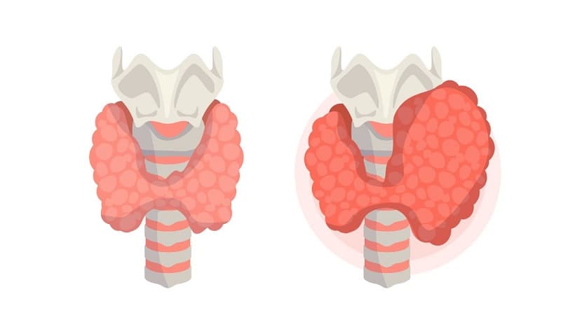 cường giáp nguyên phát là gì?