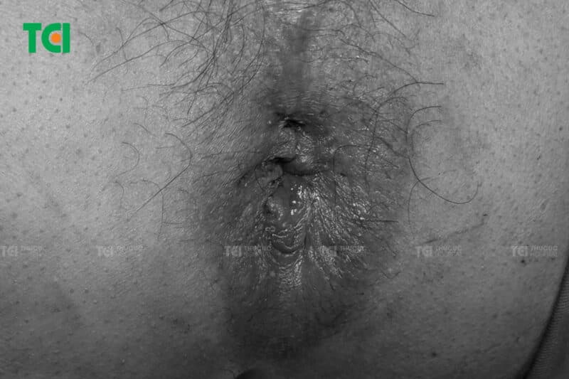 Hậu môn sau can thiệp điều trị trĩ bằng Laser Diode