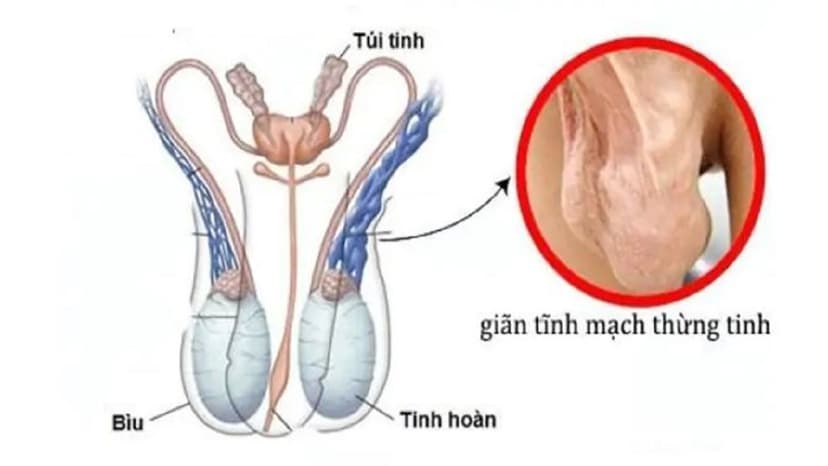 Dấu hiệu giãn tĩnh mạch thừng tinh, cơ chế, chẩn đoán và điều trị