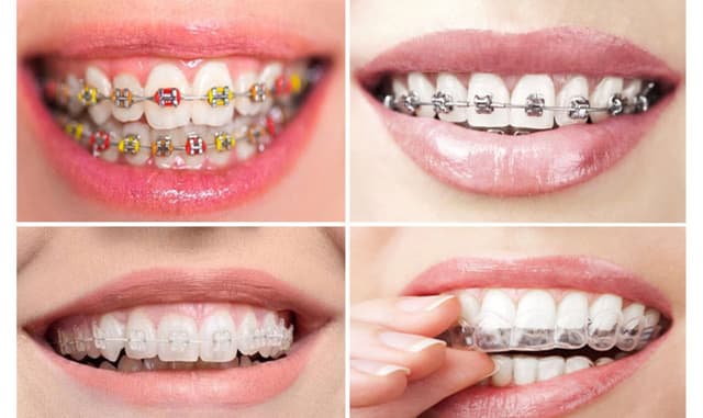 Độ tuổi niềng răng tốt nhất: Đâu là thời điểm “vàng”