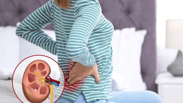 Giãn đài bể thận là như thế nào: hiểu rõ, nhận biết và phòng ngừa