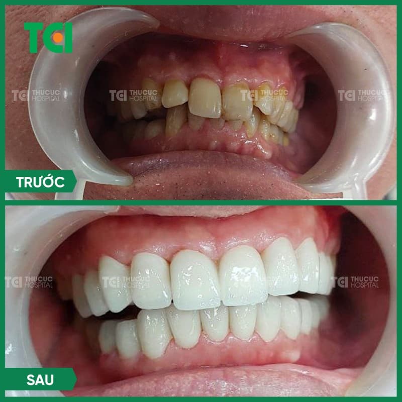 Bọc răng sứ Nacera mang lại hiệu quả thẩm mỹ tối ưu