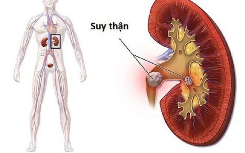 Cảnh báo các biến chứng nguy hiểm của thận ứ nước nếu không điều trị