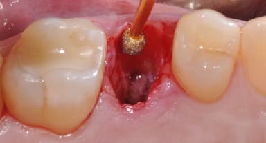 Nhổ răng khôn để lại lỗ: Bí quyết giảm sưng đau hiệu quả