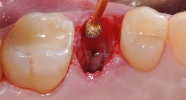 Nhổ răng khôn để lại lỗ: Bí quyết giảm sưng đau hiệu quả