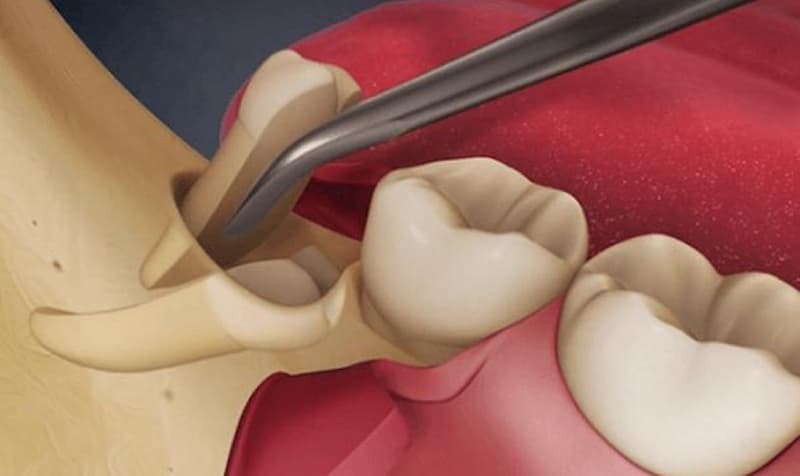 Nhổ răng khôn để lại lỗ có sao không?