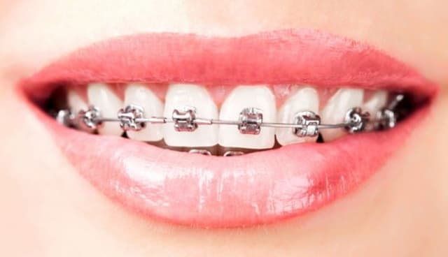 Niềng răng hô nhẹ có thực sự cần thiết hay không?