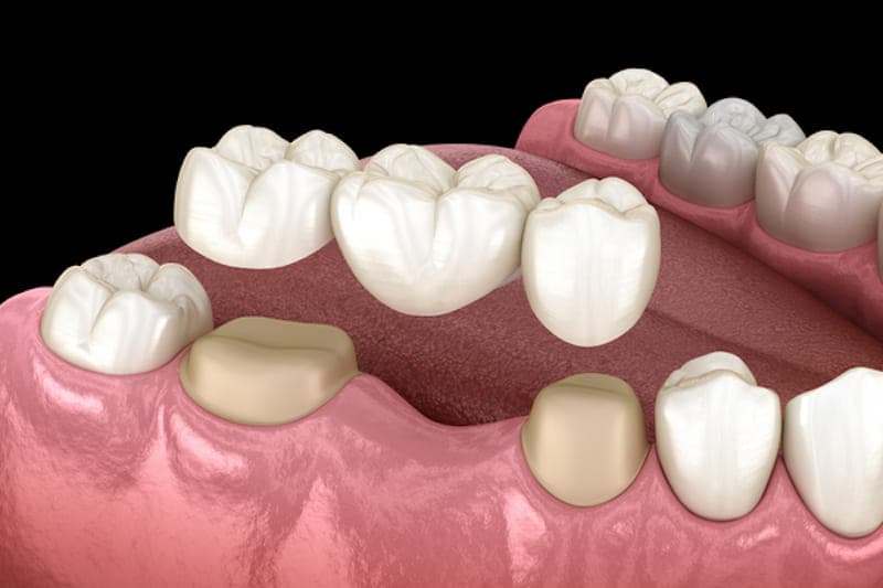Phục hình cầu răng là gì? Phương pháp tối ưu hiệu quả nhất