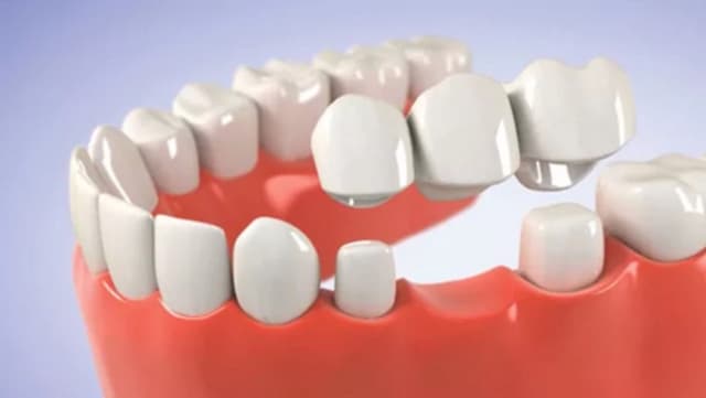 Phục hình cầu răng: Liệu có “thần kỳ” như lời đồn