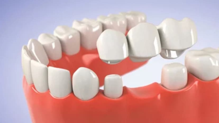 Phục hình cầu răng: Liệu có “thần kỳ” như lời đồn