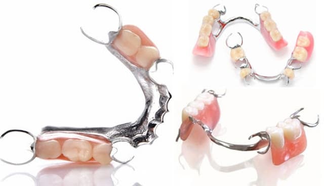 Phục hình răng giả tháo lắp có hiệu quả cho người mất răng?