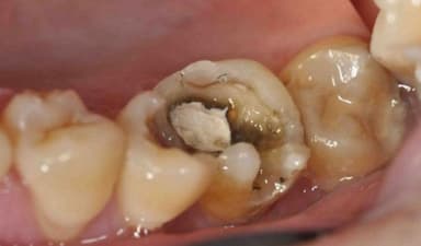 Điều trị răng bị sâu nhiều: Những điều bạn cần biết