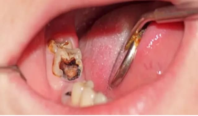 Tác hại của răng sâu bị viêm tủy và hướng điều trị