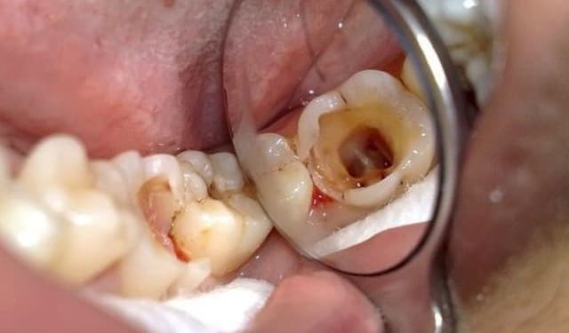 Sâu răng hàm trẻ em: Dấu hiệu nhận biết và hướng xử lý sớm