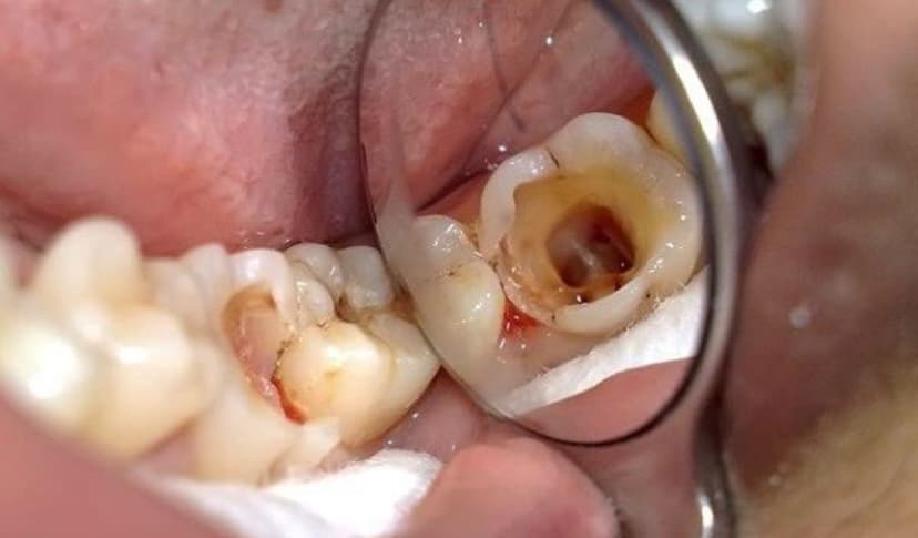 Sâu răng hàm trẻ em: Dấu hiệu nhận biết và hướng xử lý sớm