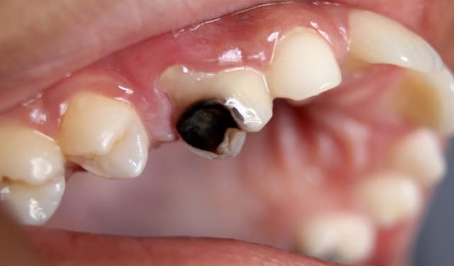Sâu răng là gì: Nguyên nhân, triệu chứng và cách phòng tránh