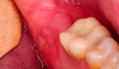 Sưng lợi răng khôn: Nguyên nhân và cách xử lý hiệu quả