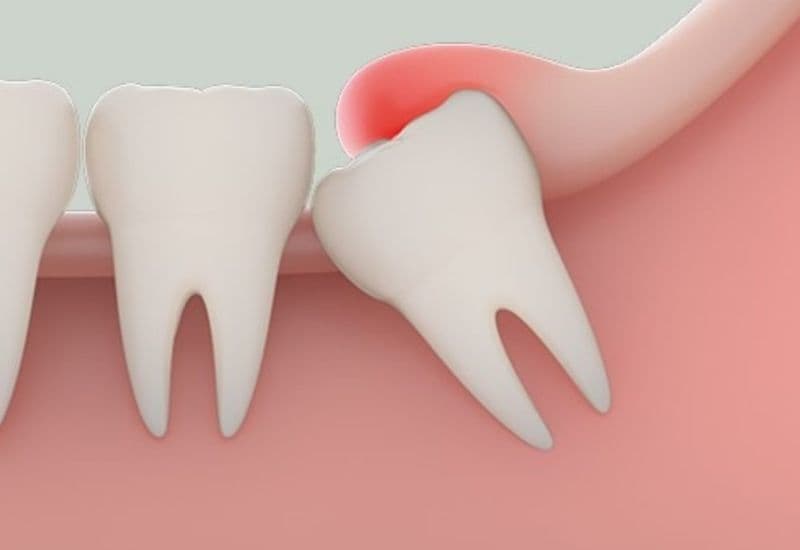 Sưng nướu răng khôn là tình trạng viêm đỏ, sưng đau quanh vùng răng khôn, đôi khi kèm theo mủ hoặc mùi hôi khó chịu.