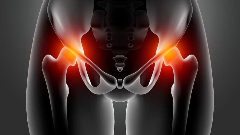 Thoái hóa khớp háng là gì ?