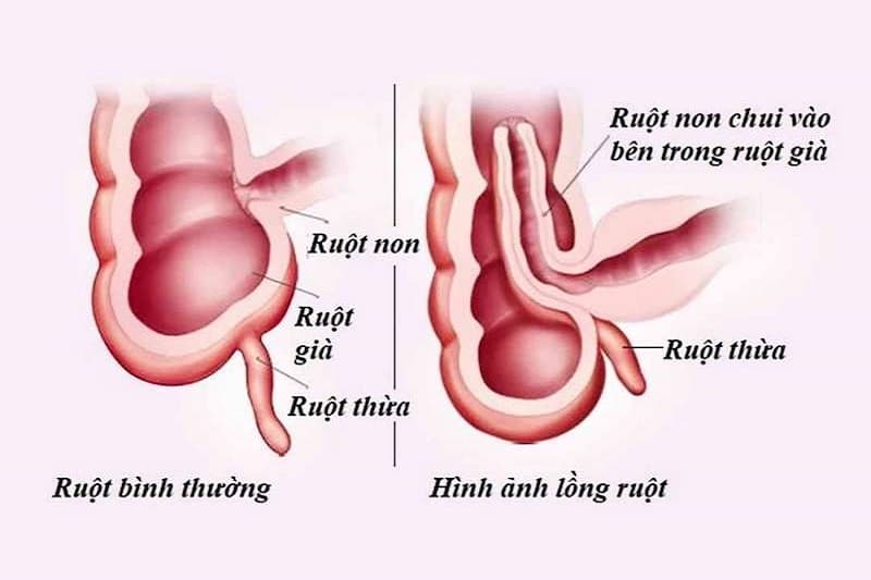 trẻ bị lồng ruột nên ăn gì - hình ảnh mô phỏng lồng ruột