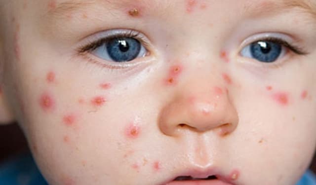 Trẻ bị thủy đậu kiêng gì và những lưu ý cha mẹ cần nhớ