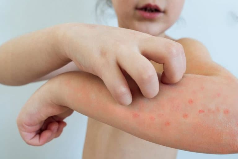 Khi mắc thủy đậu, dù cảm thấy ngứa ngáy khó chịu, trẻ vẫn cần tuyệt đối tránh gãi hay cào vào các nốt phồng rộp.