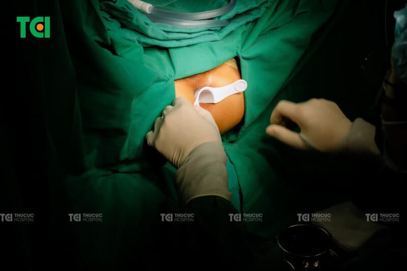 Đốt trĩ Laser Diode tại TCI