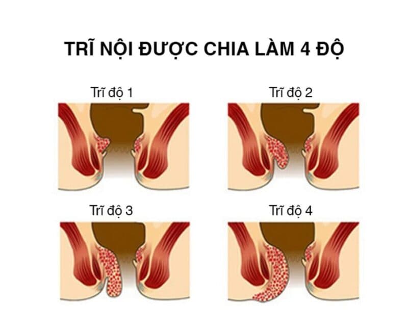 trĩ nội cấp độ 4