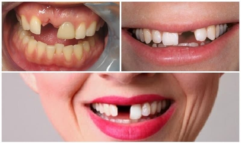 Trồng răng cửa có duy trì được lâu dài không?