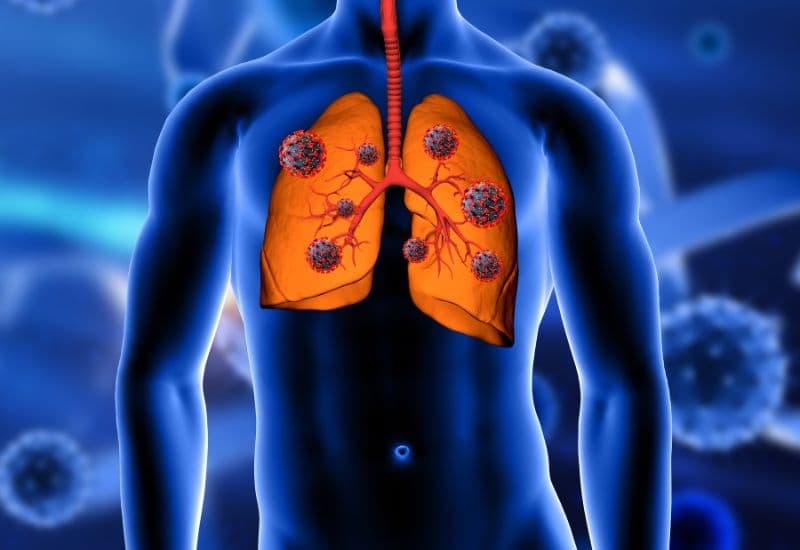 Ung thư phổi có ăn được thịt chó không - Ung thư phổi là loại ung thư phổ biến nhất, với các triệu chứng như ho kéo dài, khó thở, đau ngực và sụt cân nhanh chóng.