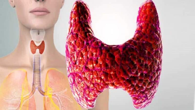 Hashimoto là dạng viêm tuyến giáp mạn tính phổ biến nhất