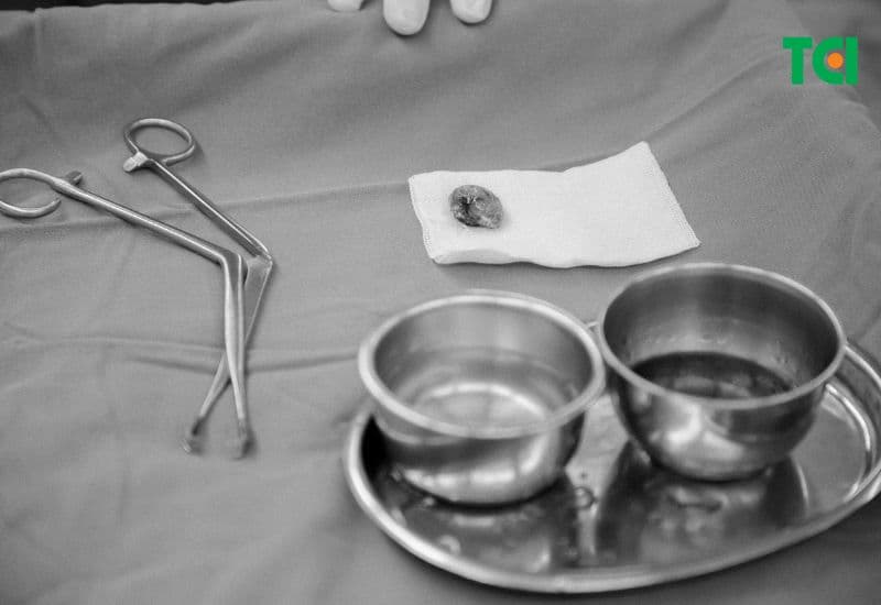 TCI đã giúp anh T. xóa sổ tình trạng viêm amidan mãn tính quá phát