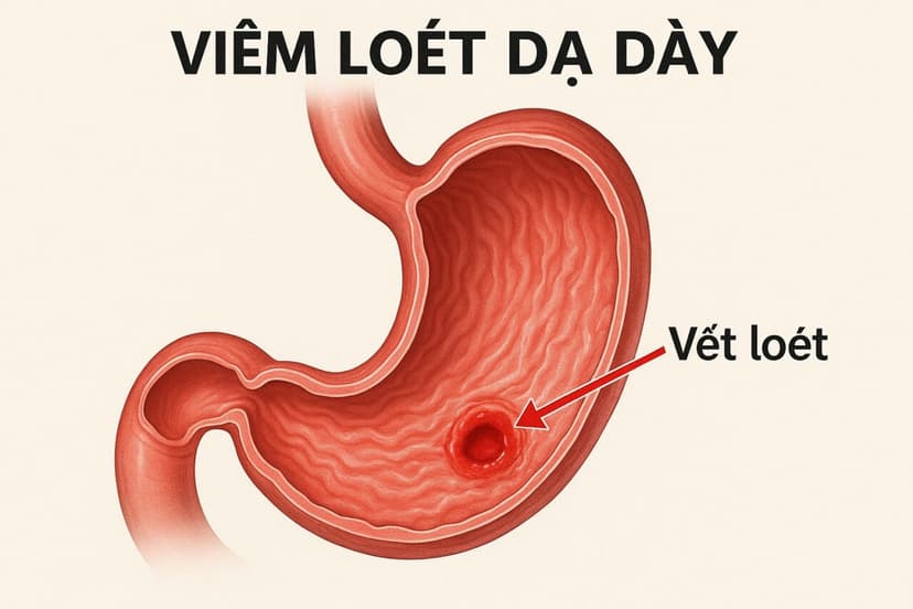 Giải đáp bị loét dạ dày có nguy hiểm không, nên ăn uống thế nào