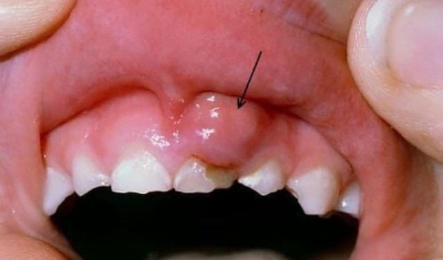 Nguyên nhân và cách khắc phục hiệu quả khi trẻ 3 tuổi bị viêm lợi