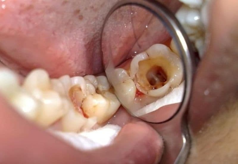 Nguyên nhân chính khiến trẻ em sâu răng hàm thường xuất phát từ thói quen vệ sinh răng miệng chưa đúng cách.