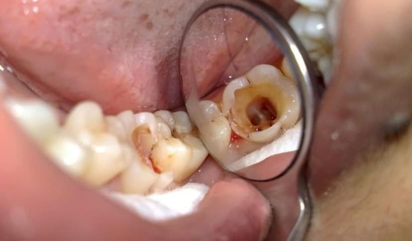 Trẻ em sâu răng hàm: Dấu hiệu và biện pháp phòng ngừa