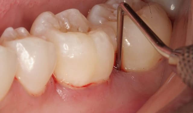 Nguyên nhân và triệu chứng thường gặp khi đau lợi răng khôn