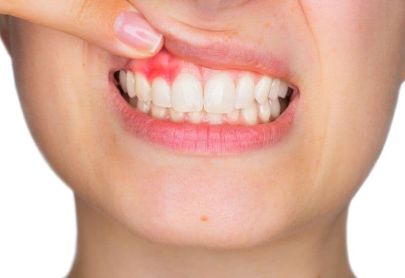 Đau răng viêm lợi là tình trạng răng xuất hiện cảm giác đau nhức, đi kèm với nướu bị sưng đỏ và dễ chảy máu trong quá trình ăn nhai hay chải răng.