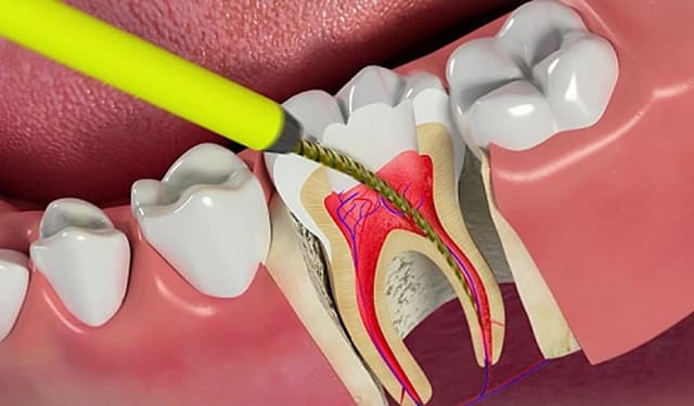 Lợi ích của việc điều trị lấy tủy răng đúng thời điểm